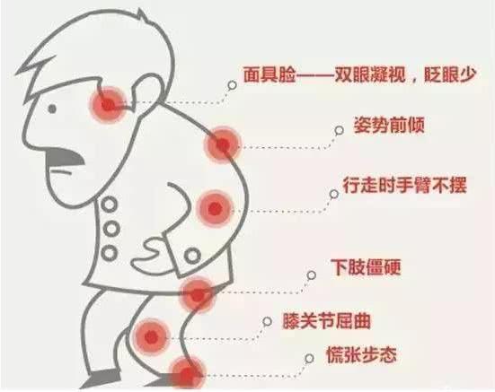 帕金森病的症状有哪些？