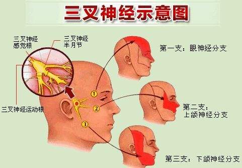 三叉神经痛常见的诱因有哪些